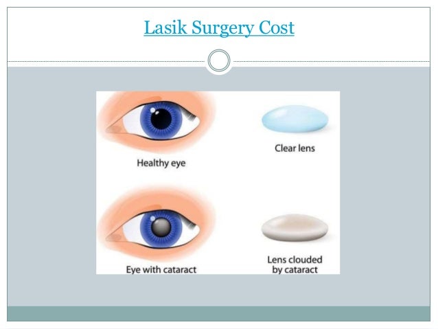 Cost of lasix eye surgery