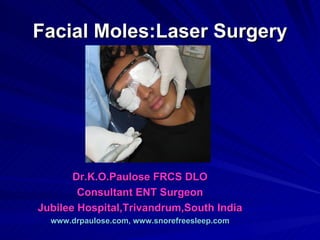 Facial Moles:Laser Surgery




       Dr.K.O.Paulose FRCS DLO
        Consultant ENT Surgeon
Jubilee Hospital,Trivandrum,South India
  www.drpaulose.com, www.snorefreesleep.com
 