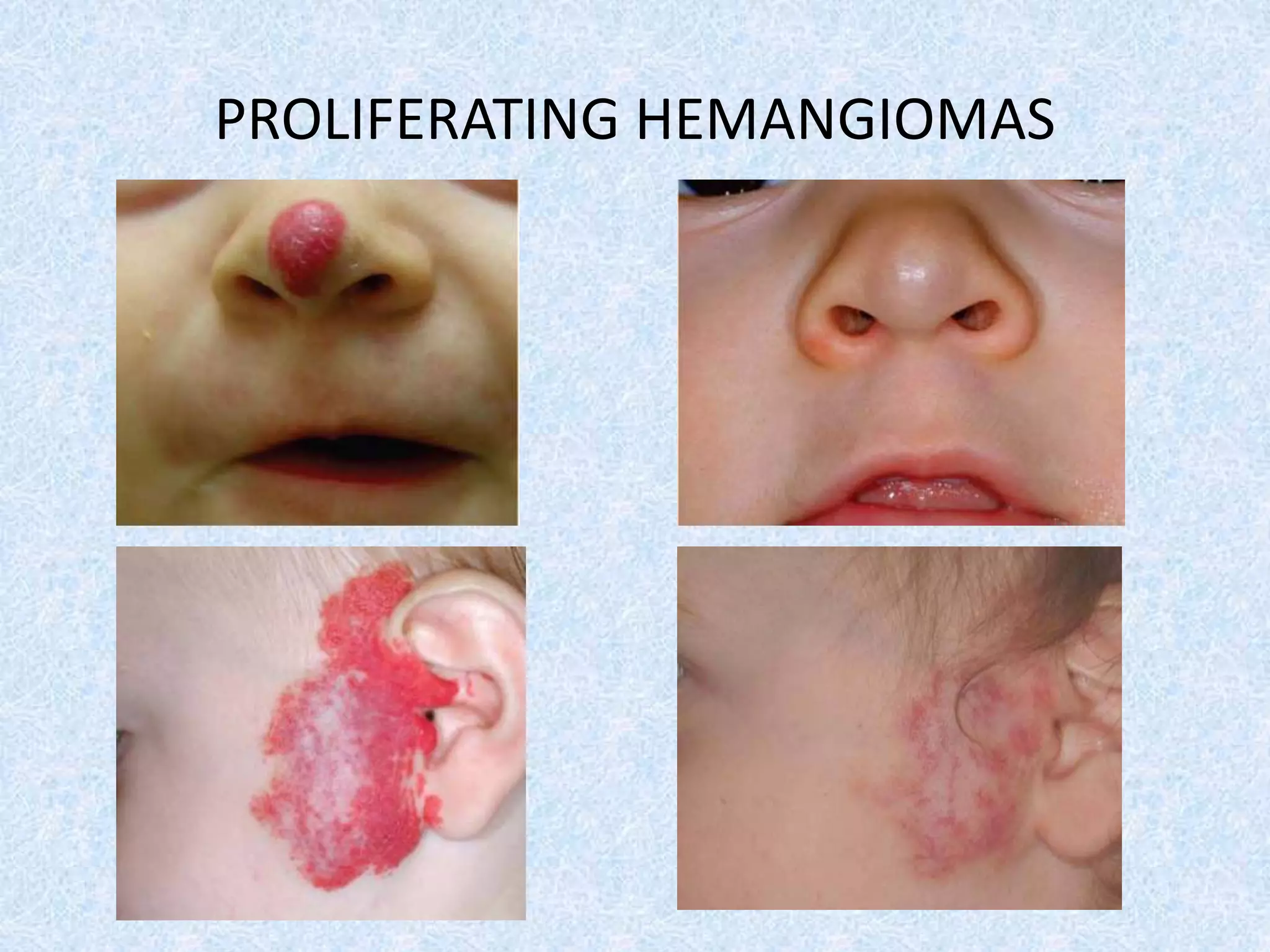 PROLIFERATING HEMANGIOMAS 
 