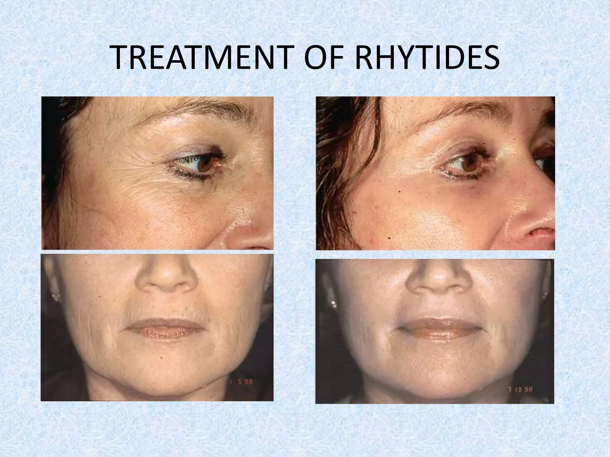 TREATMENT OF RHYTIDES 
 