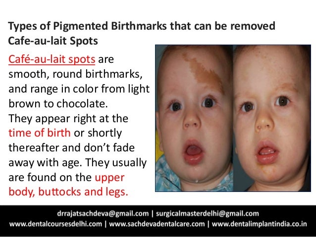 Laser for tattoo and birthmark removal Laser for tattoo and birthmark removal