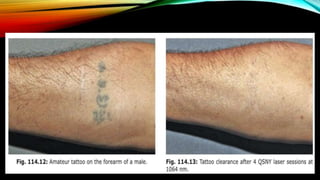 Laser for tattoo removal.pptx