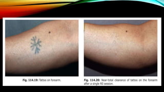 Laser for tattoo removal.pptx