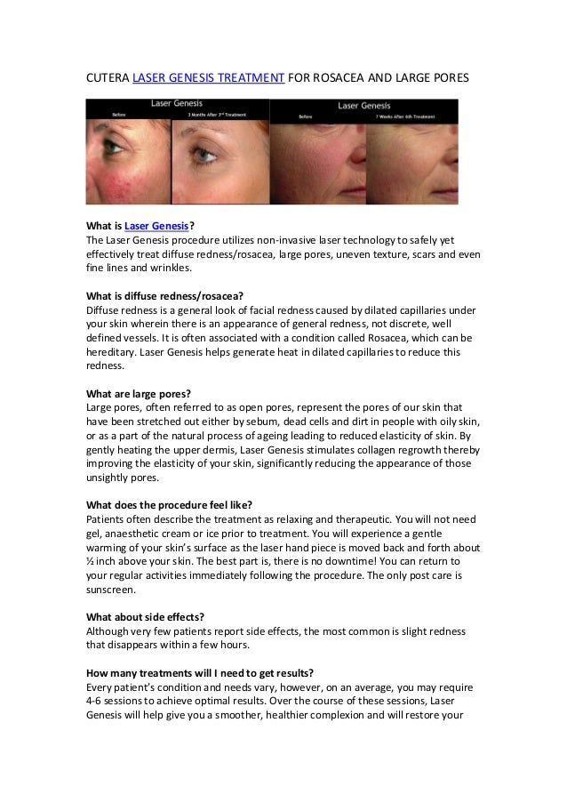 Laser genesis rosacea open pores