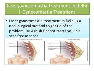 laser gynecomastia treatment in delhi
| Gynecomastia Treatment
• Laser gynecomastia treatment in Delhi is a
non- surgical method to get rid of the
problem. Dr. Ashish Bhanot treats you in a
scar-free manner .
 