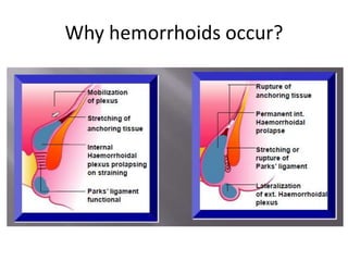 Why hemorrhoids occur?
 