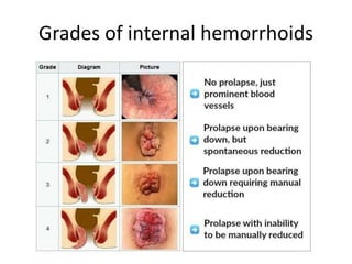 Grades of internal hemorrhoids
 