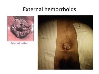 External hemorrhoids
 