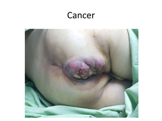 Cancer
 