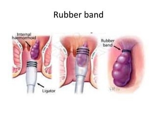 Rubber band
 
