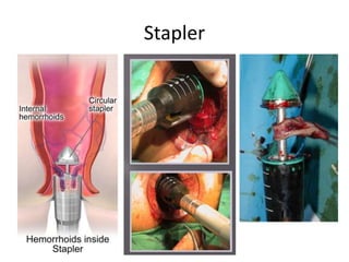 Stapler
 
