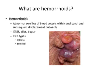 What are hemorrhoids?
• Hemorrhoids
– Abnormal swelling of blood vessels within anal canal and
subsequent displacement outwards
– 痔疮, piles, buasir
– Two types
• Internal
• External
 