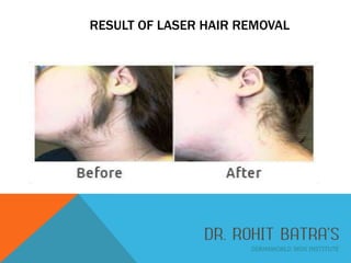 RESULT OF LASER HAIR REMOVAL

 