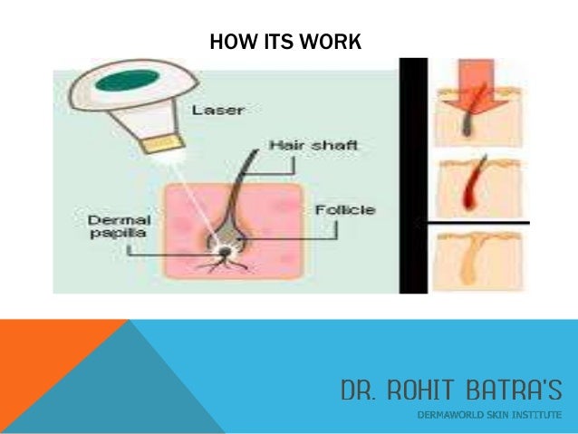 Laser Hair Removal Pain Free Hair Free