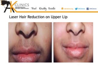 Laser Hair Reduction on Upper Lip
v
 