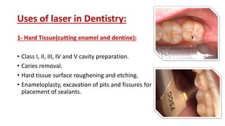 Uses of laser in Dentistry:
1- Hard Tissue(cutting enamel and dentine):
• Class I, II, III, IV and V cavity preparation.
• Caries removal.
• Hard tissue surface roughening and etching.
• Enameloplasty, excavation of pits and fissures for
placement of sealants.
 