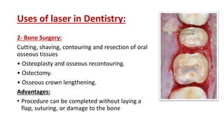 Uses of laser in Dentistry:
2- Bone Surgery:
Cutting, shaving, contouring and resection of oral
osseous tissues
• Osteoplasty and osseous recontouring.
• Ostectomy.
• Osseous crown lengthening.
Advantages:
• Procedure can be completed without laying a
flap, suturing, or damage to the bone
 