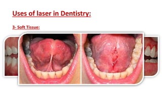 Uses of laser in Dentistry:
3- Soft Tissue:
 