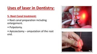 Uses of laser in Dentistry:
5- Root Canal treatment:
• Root canal preparation including
enlargement.
• Pulpotomy.
• Apicoectomy – amputation of the root
end.
 