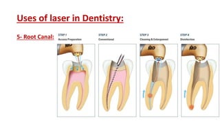 Uses of laser in Dentistry:
5- Root Canal:
 