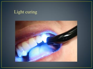 Light curing