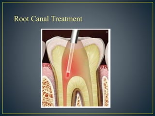 Root Canal Treatment