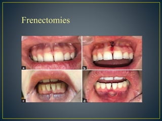 Frenectomies