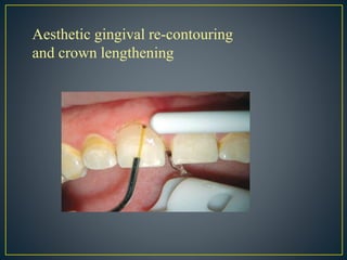 Aesthetic gingival re-contouring
and crown lengthening