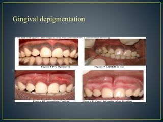 Gingival depigmentation