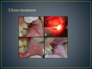 Ulcers treatment
