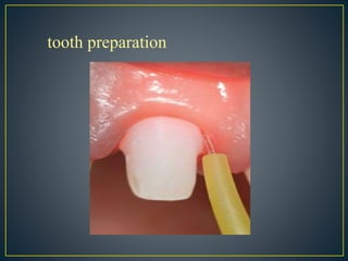 tooth preparation