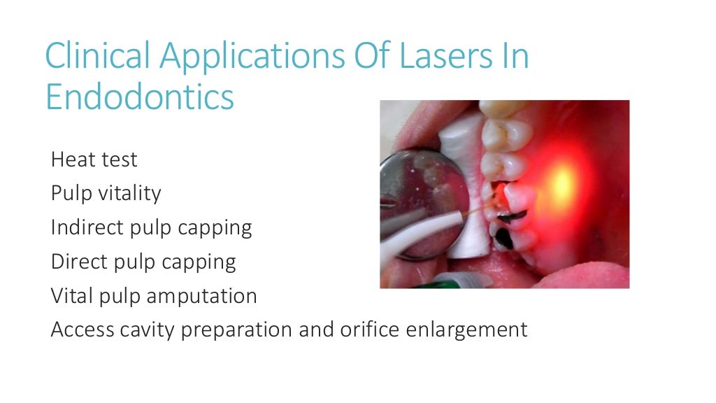 Laser in Endodontics