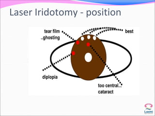 Laser Iridotomy - position 
 