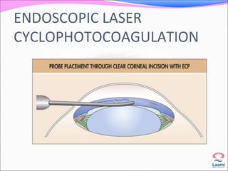ENDOSCOPIC LASER 
CYCLOPHOTOCOAGULATION 
 