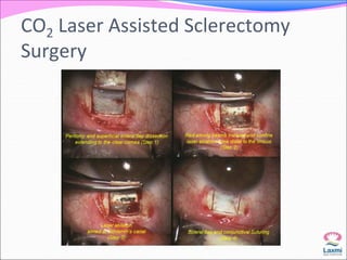 CO2 Laser Assisted Sclerectomy 
Surgery 
 