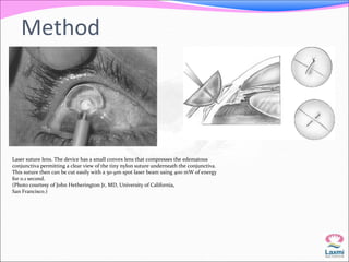 Method 
Laser suture lens. The device has a small convex lens that compresses the edematous 
conjunctiva permitting a clear view of the tiny nylon suture underneath the conjunctiva. 
This suture then can be cut easily with a 50-μm spot laser beam using 400 mW of energy 
for 0.1 second. 
(Photo courtesy of John Hetherington Jr, MD, University of California, 
San Francisco.) 
 