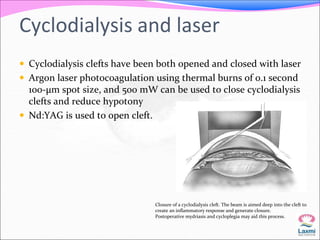 Cyclodialysis and laser 
 Cyclodialysis clefts have been both opened and closed with laser 
 Argon laser photocoagulation using thermal burns of 0.1 second 
100-μm spot size, and 500 mW can be used to close cyclodialysis 
clefts and reduce hypotony 
 Nd:YAG is used to open cleft. 
Closure of a cyclodialysis cleft. The beam is aimed deep into the cleft to 
create an inflammatory response and generate closure. 
Postoperative mydriasis and cycloplegia may aid this process. 
 