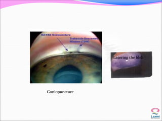 Goniopuncture 
Lasering the bleb 
 
