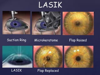 LASIK
SURYA
Suction Ring Microkeratome Flap Raised
LASIK Flap Replaced
 