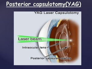 Posterior capsulotomy(YAG)
 
