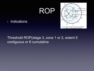 Laser in ophthalmology | PPTX