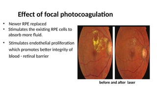 Fluid Under Rpe Laser in retina Ophthalmology By Dr. Eva | PPTX