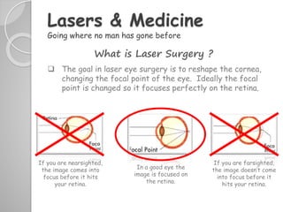 What is Laser Surgery ?
 The goal in laser eye surgery is to reshape the cornea,
changing the focal point of the eye. Ideally the focal
point is changed so it focuses perfectly on the retina.
Lasers & Medicine
Going where no man has gone before
If you are nearsighted,
the image comes into
focus before it hits
your retina.
If you are farsighted,
the image doesn’t come
into focus before it
hits your retina.
In a good eye the
image is focused on
the retina.
 