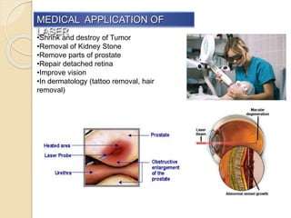 •Shrink and destroy of Tumor
•Removal of Kidney Stone
•Remove parts of prostate
•Repair detached retina
•Improve vision
•In dermatology (tattoo removal, hair
removal)
MEDICAL APPLICATION OF
LASER