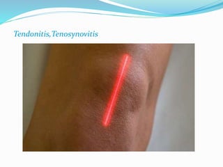 Tendonitis,Tenosynovitis 
 