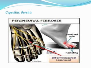 Capsulitis, Bursitis 
 