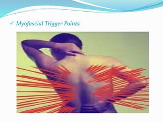  Myofascial Trigger Points 
 