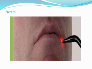 Herpes 
 