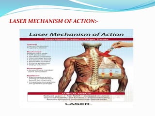 LASER MECHANISM OF ACTION:- 
 