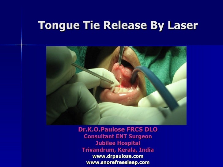 Laser Release Tongue Tie